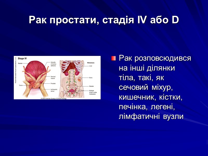 Рак простати, стадія IV або D Рак розповсюдився на інші ділянки тіла, такі, як